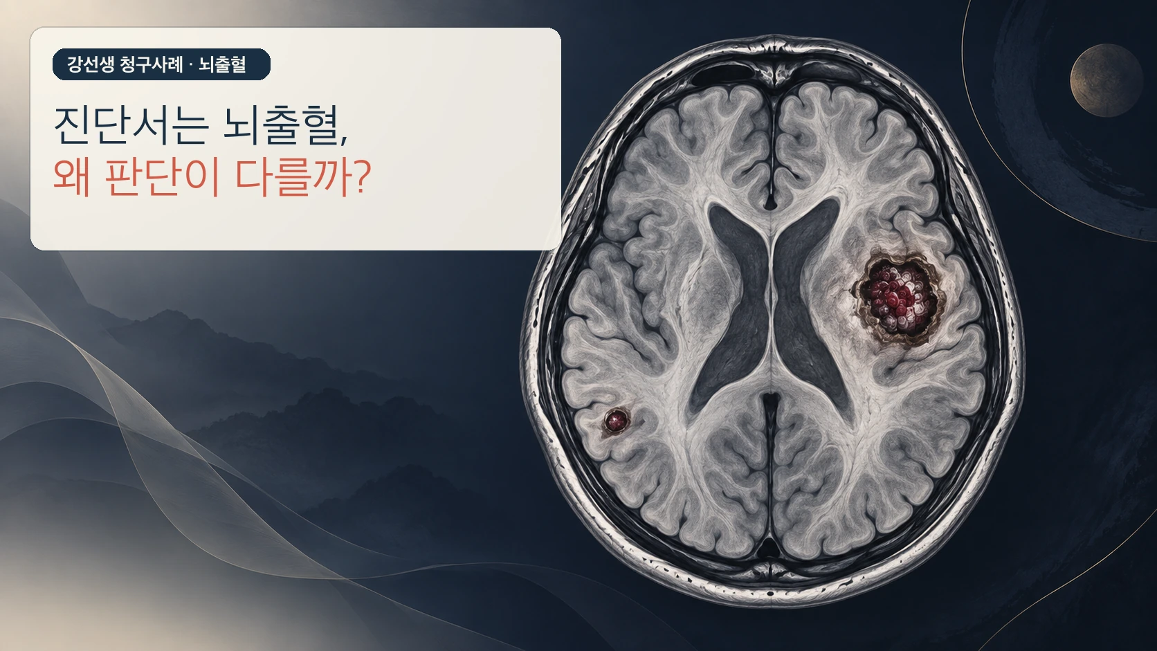 뇌 해면상 혈관종 병변과 떨어진 위치의 작은 출혈을 함께 보여주는 이해용 MRI 형태 그림
