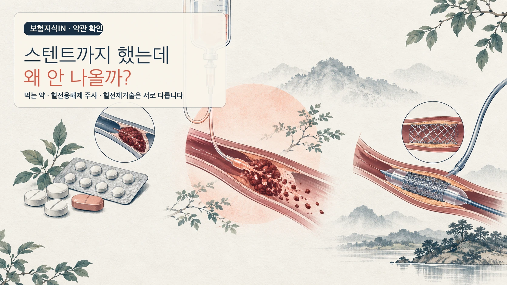 먹는 약, 혈전용해제 주사와 카테터·스텐트 치료를 세 갈래로 보여주는 혈전용해치료비 안내